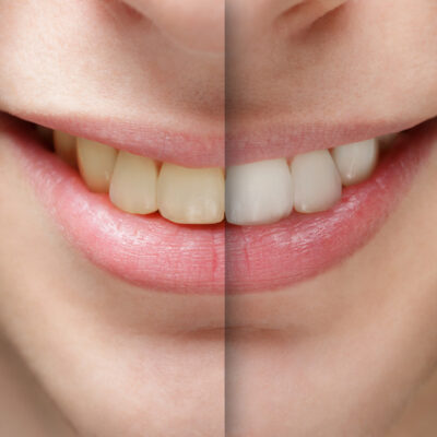 young man smile before and after teeth whitening, close up