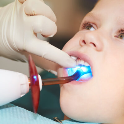 child teeth stopping treatment with dental curing ultraviolet light equipment