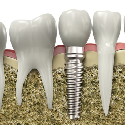 Very high resolution 3d rendering of a dental implant