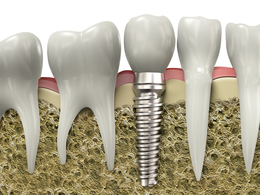 implantaty_-_photodune-7358806-dental-implant-s