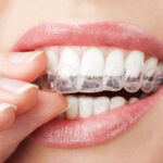 vyroba_nosicu_pro_domaci_beleni_-_photodune-2921403-teeth-with-whitening-tray-s