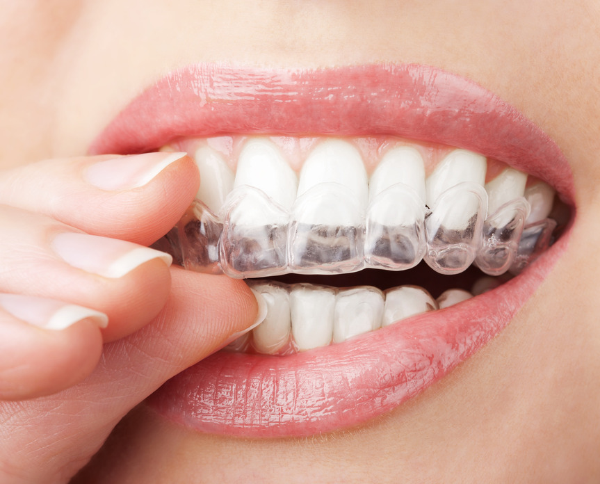 vyroba_nosicu_pro_domaci_beleni_-_photodune-2921403-teeth-with-whitening-tray-s